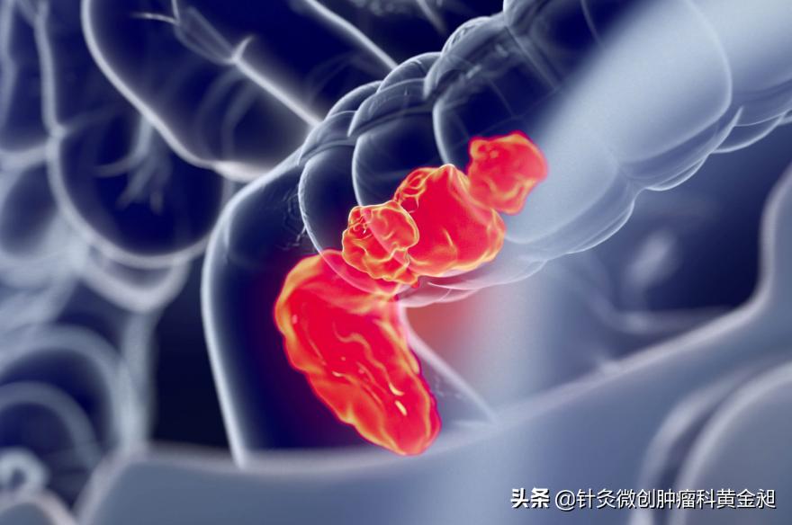 高血壓最新分期與分級(jí)解讀，全面梳理與解讀標(biāo)準(zhǔn)更新內(nèi)容